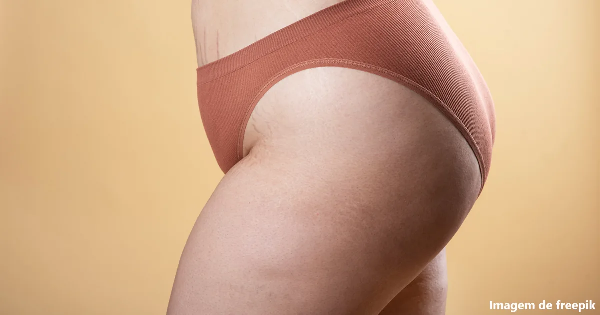 Guia Completo Sobre Lipedema nas Pernas: Sintomas, Causas e Tratamentos